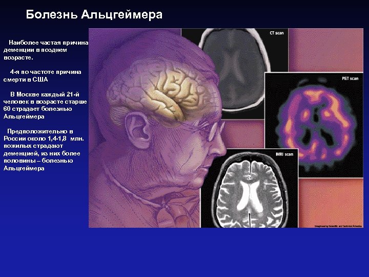 Болезнь Альцгеймера Наиболее частая причина деменции в позднем возрасте. 4 -я по частоте причина