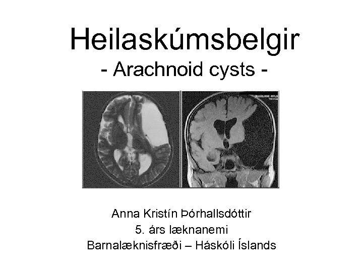 Heilaskúmsbelgir - Arachnoid cysts - Anna Kristín Þórhallsdóttir 5. árs læknanemi Barnalæknisfræði – Háskóli