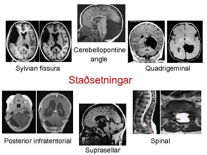  Cerebellopontine angle Sylvian fissura Quadrigeminal Staðsetningar Posterior infratentorial Suprasellar Spinal 