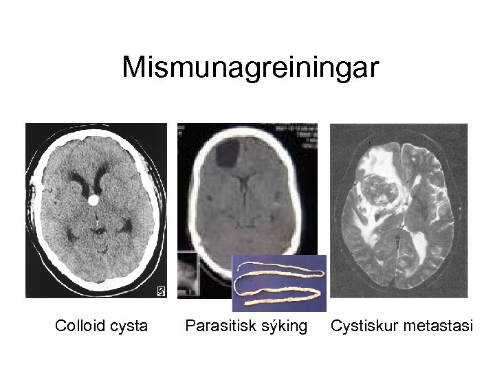  Mismunagreiningar Colloid cysta Parasitisk sýking Cystiskur metastasi 