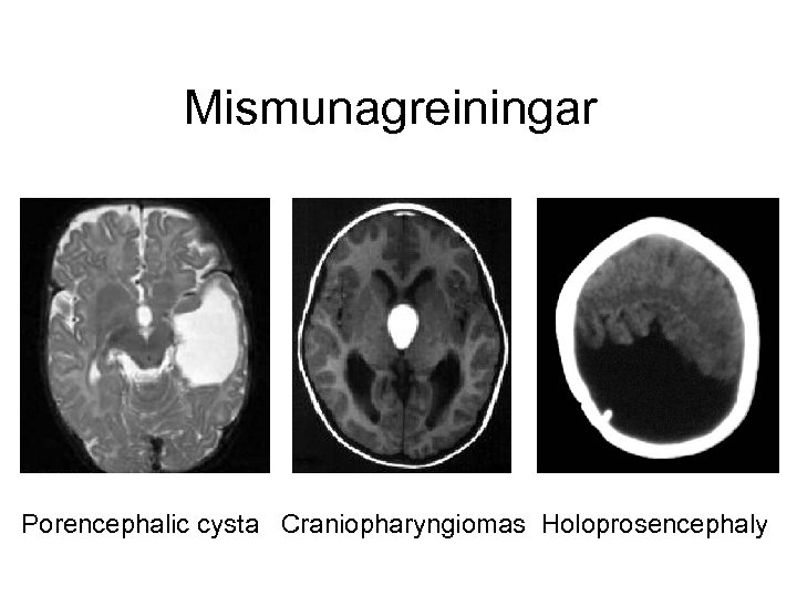  Mismunagreiningar Porencephalic cysta Craniopharyngiomas Holoprosencephaly 