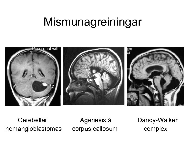  Mismunagreiningar Cerebellar Agenesis á Dandy-Walker hemangioblastomas corpus callosum complex 