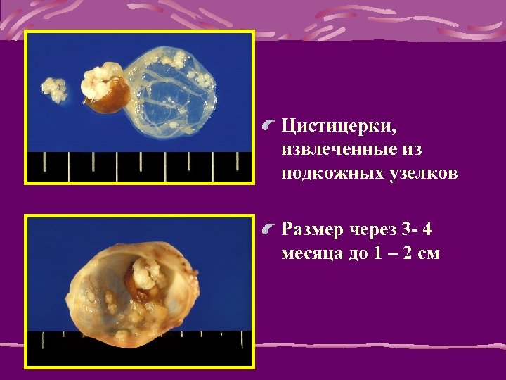 Цистицерки, извлеченные из подкожных узелков Размер через 3 - 4 месяца до 1 –