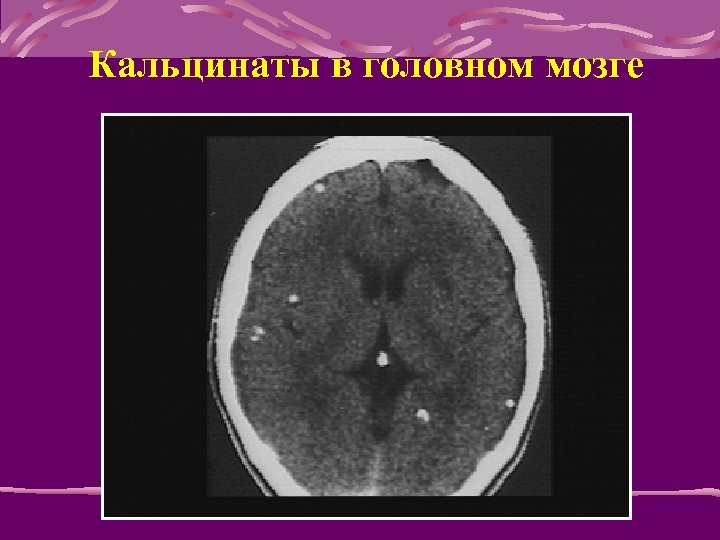 Кальцинаты в головном мозге 