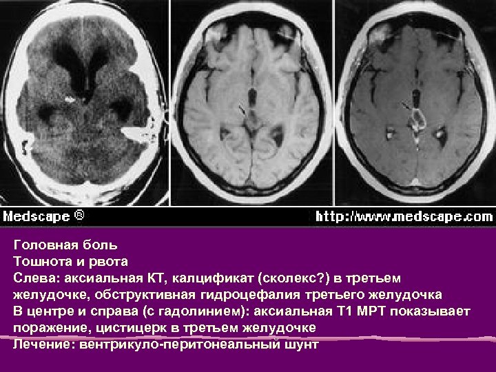 Головная боль Тошнота и рвота Слева: аксиальная КТ, калцификат (сколекс? ) в третьем желудочке,