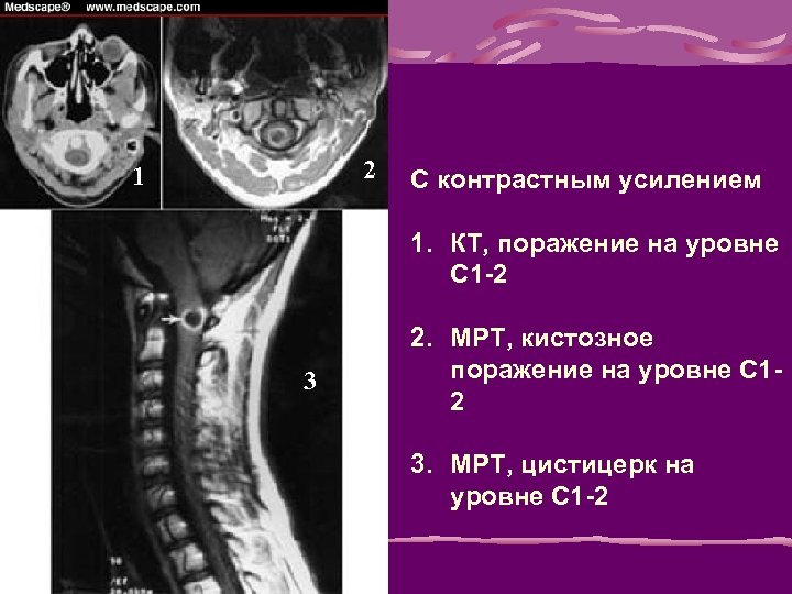 2 1 С контрастным усилением 1. КТ, поражение на уровне С 1 -2 3