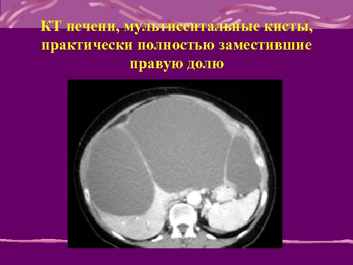 КТ печени, мультисептальные кисты, практически полностью заместившие правую долю 