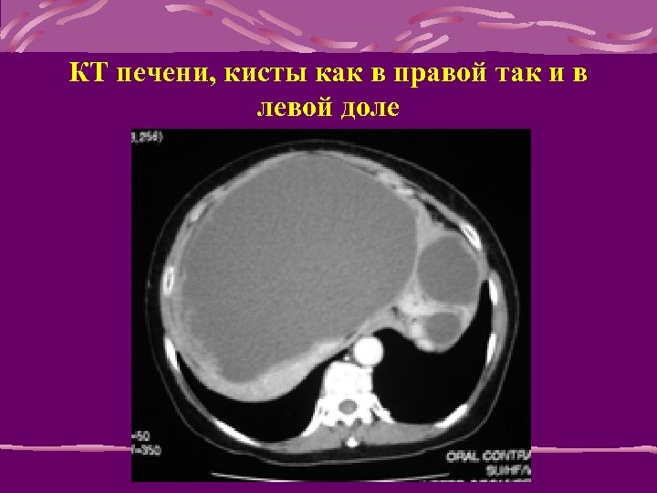 КТ печени, кисты как в правой так и в левой доле 
