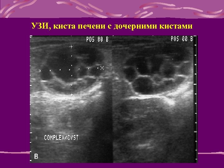 УЗИ, киста печени с дочерними кистами 