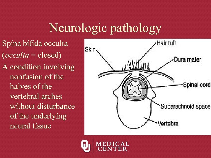 Neurologic pathology Spina bifida occulta (occulta = closed) A condition involving nonfusion of the