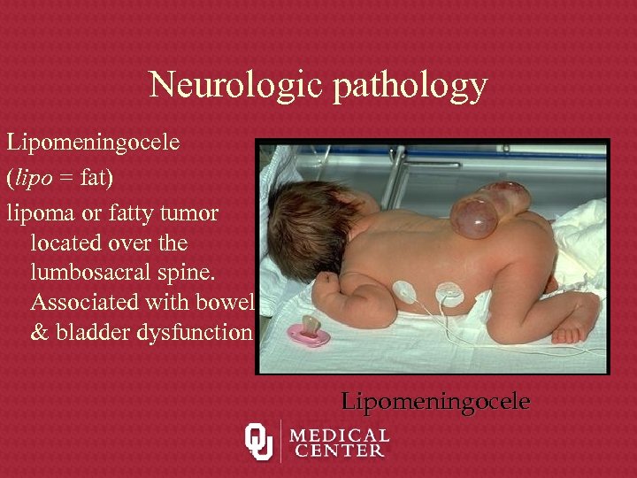 Neurologic pathology Lipomeningocele (lipo = fat) lipoma or fatty tumor located over the lumbosacral