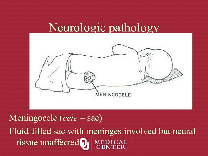 Neurologic pathology Meningocele (cele = sac) Fluid-filled sac with meninges involved but neural tissue