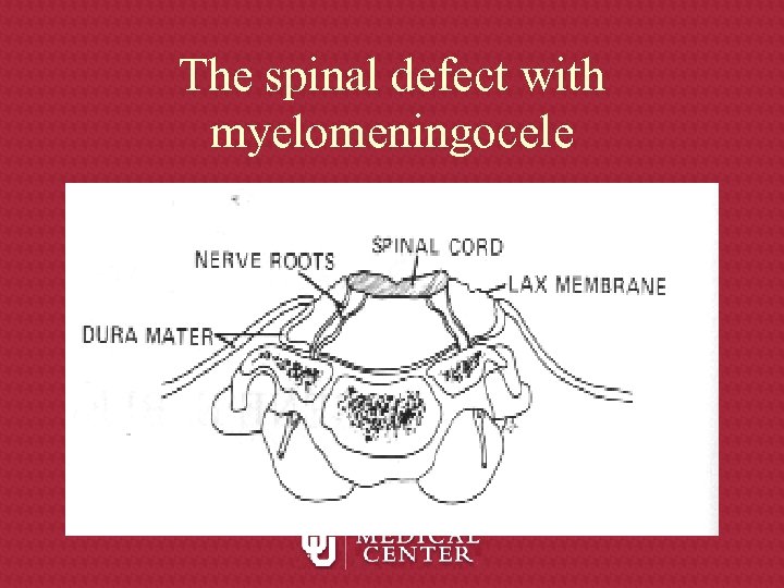 The spinal defect with myelomeningocele 