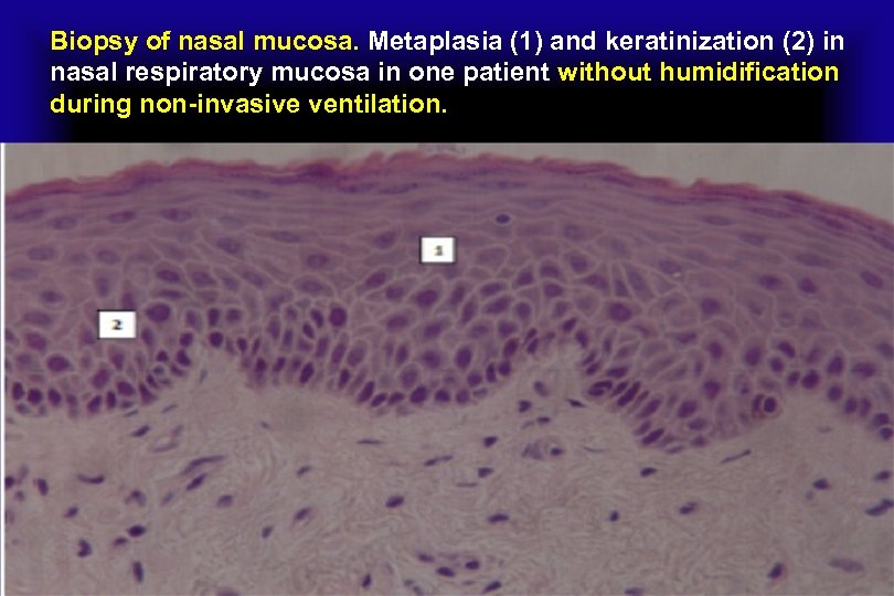 Biopsy of nasal mucosa. Metaplasia (1) and keratinization (2) in nasal respiratory mucosa in