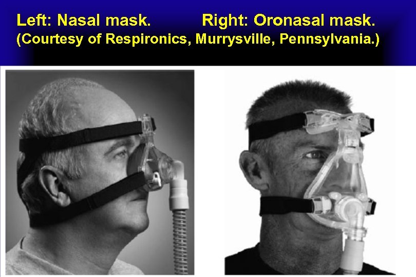 Left: Nasal mask. Right: Oronasal mask. (Courtesy of Respironics, Murrysville, Pennsylvania. ) 