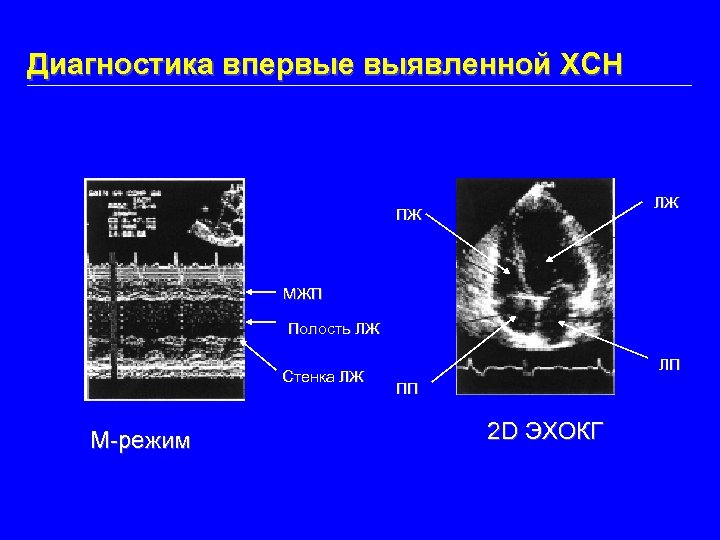 Диагностика впервые выявленной ХСН ЛЖ ПЖ МЖП Полость ЛЖ Стенка ЛЖ M-режим ЛП ПП