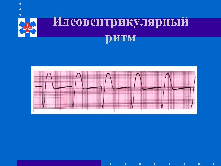 Идеовентрикулярный ритм 