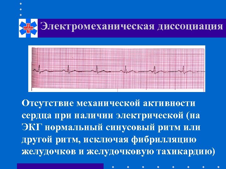 Электромеханическая диссоциация Отсутствие механической активности сердца при наличии электрической (на ЭКГ нормальный синусовый ритм