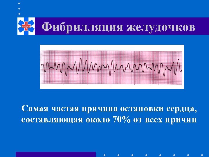 Фибрилляция желудочков Самая частая причина остановки сердца, составляющая около 70% от всех причин 