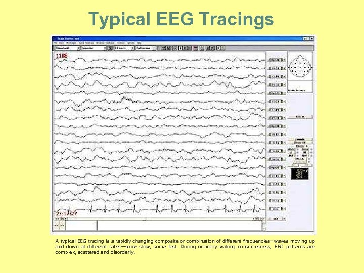 Typical EEG Tracings A typical EEG tracing is a rapidly changing composite or combination