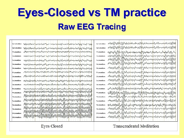 Eyes-Closed vs TM practice Raw EEG Tracing 