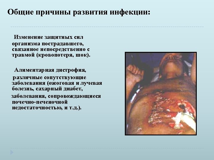 Общие причины развития инфекции: Изменение защитных сил организма пострадавшего, связанное непосредственно с травмой (кровопотеря,
