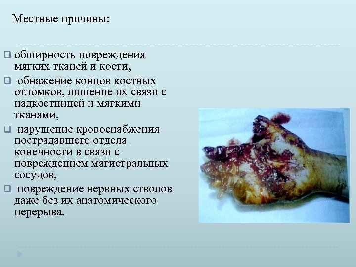 Местные причины: q обширность повреждения мягких тканей и кости, q обнажение концов костных отломков,