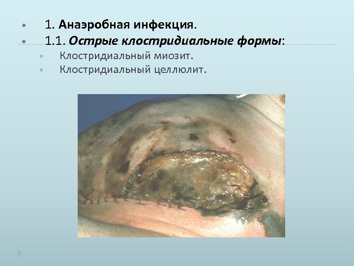  • • 1. Анаэробная инфекция. 1. 1. Острые клостридиальные формы: • Клостридиальный миозит.