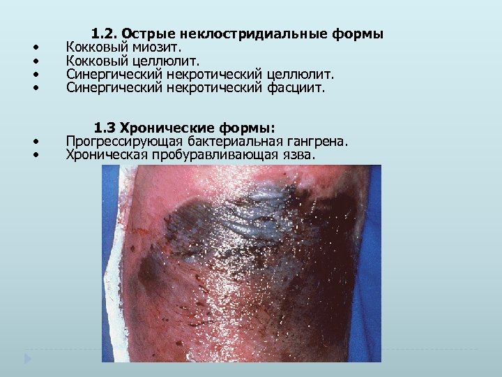  • • 1. 2. Острые неклостридиальные формы Кокковый миозит. Кокковый целлюлит. Синергический некротический