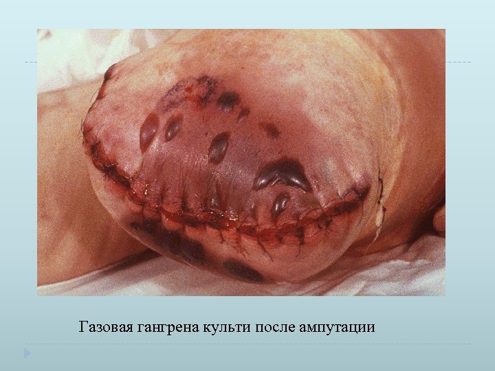  Газовая гангрена культи после ампутации 