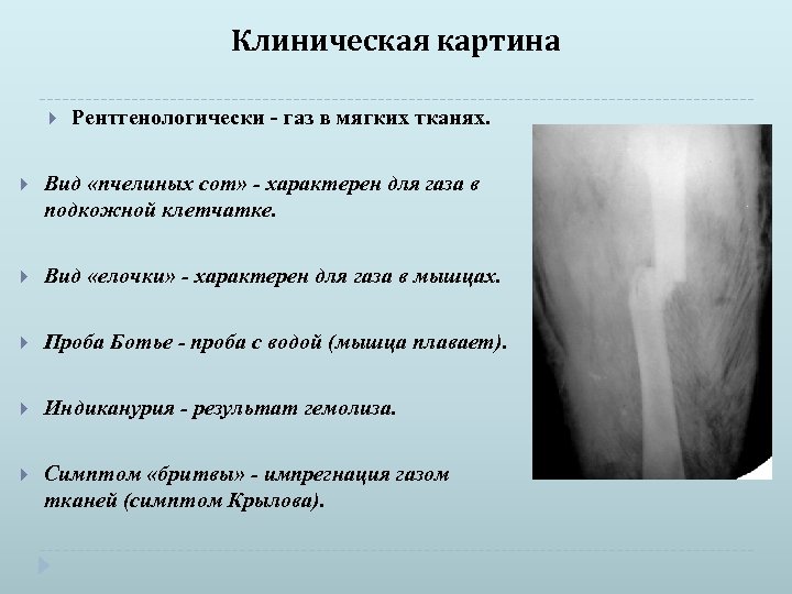 Клиническая картина Рентгенологически - газ в мягких тканях. Вид «пчелиных сот» - характерен для