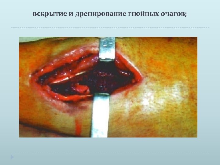 вскрытие и дренирование гнойных очагов; 