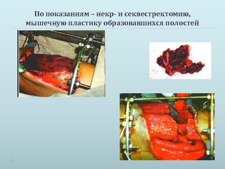 По показаниям – некр- и секвестректомию, мышечную пластику образовавшихся полостей 