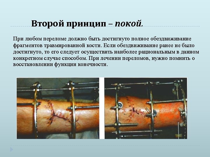 Второй принцип – покой. При любом переломе должно быть достигнуто полное обездвиживание фрагментов травмированной