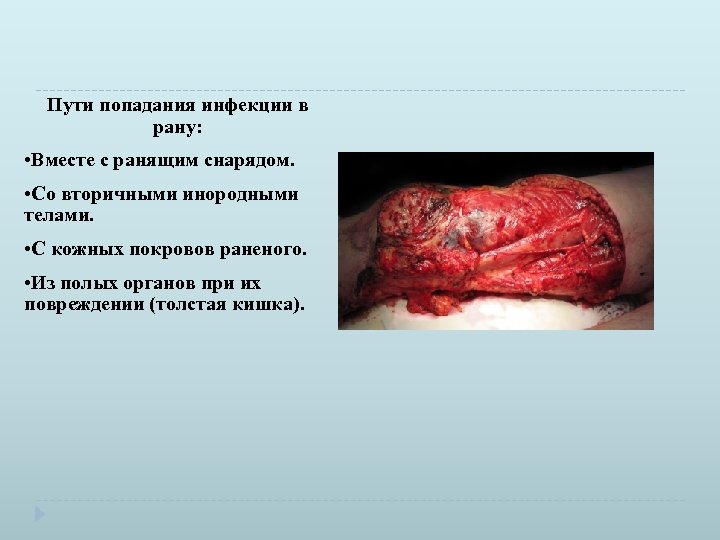 Пути попадания инфекции в рану: • Вместе с ранящим снарядом. • Со вторичными инородными