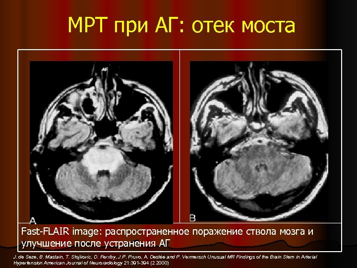 МРТ при АГ: отек моста Fast-FLAIR image: распространенное поражение ствола мозга и улучшение после