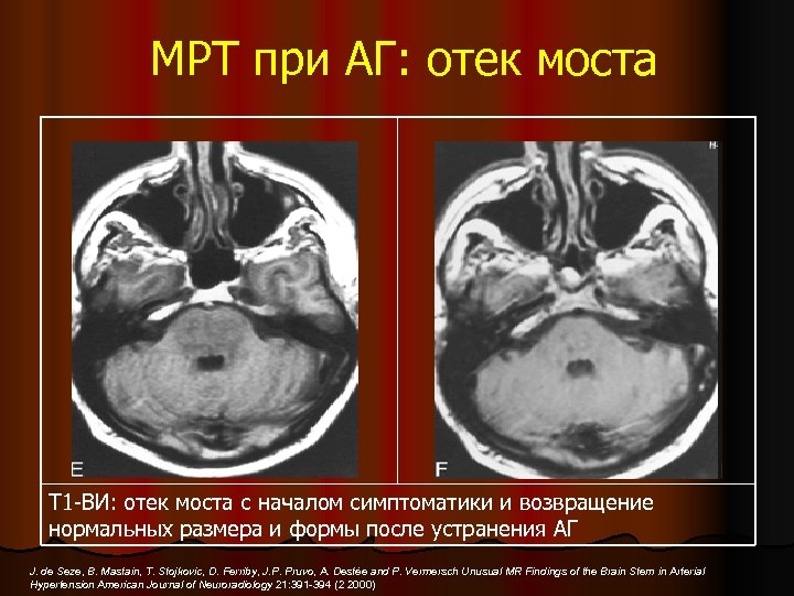 МРТ при АГ: отек моста Т 1 -ВИ: отек моста с началом симптоматики и