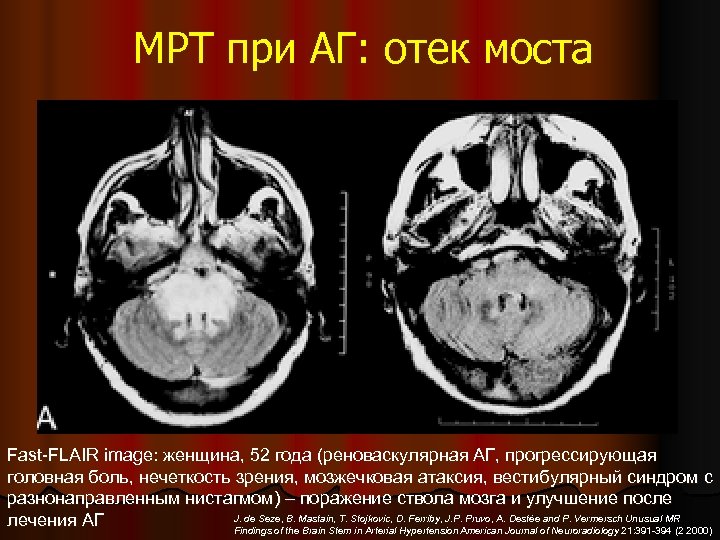 МРТ при АГ: отек моста Fast-FLAIR image: женщина, 52 года (реноваскулярная АГ, прогрессирующая головная