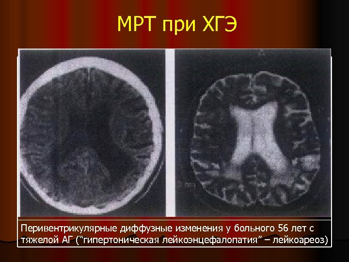 МРТ при ХГЭ Перивентрикулярные диффузные изменения у больного 56 лет с тяжелой АГ (“гипертоническая