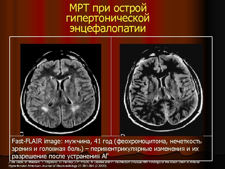МРТ при острой гипертонической энцефалопатии Fast-FLAIR image: мужчина, 41 год (феохромоцитома, нечеткость зрения и
