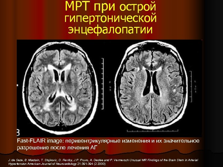 МРТ при острой гипертонической энцефалопатии Fast-FLAIR image: перивентрикулярные изменения и их значительное разрешение после