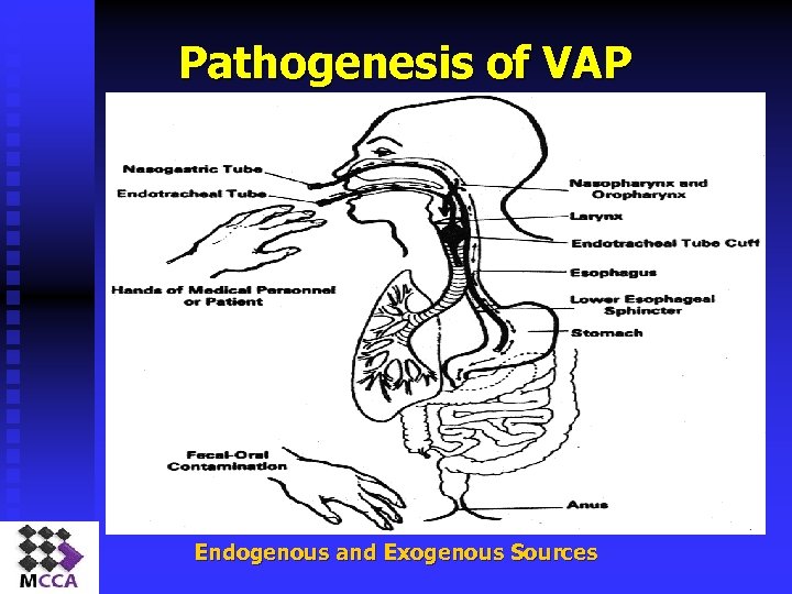 Pathogenesis of VAP Endogenous and Exogenous Sources 