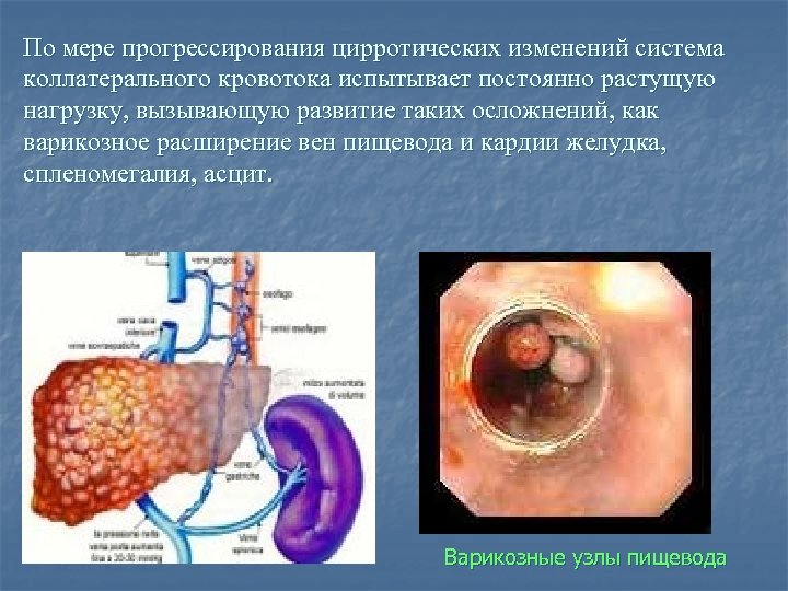 По мере прогрессирования цирротических изменений система коллатерального кровотока испытывает постоянно растущую нагрузку, вызывающую развитие