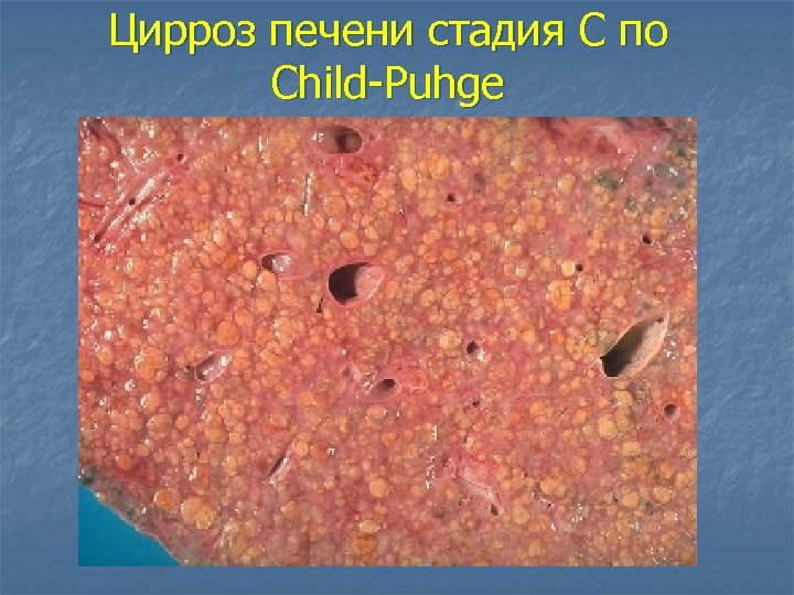 Цирроз печени стадия С по Child-Puhge 