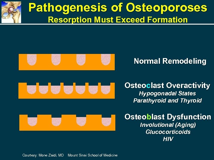 Pathogenesis of Osteoporoses Resorption Must Exceed Formation Normal Remodeling Osteoclast Overactivity Hypogonadal States Parathyroid