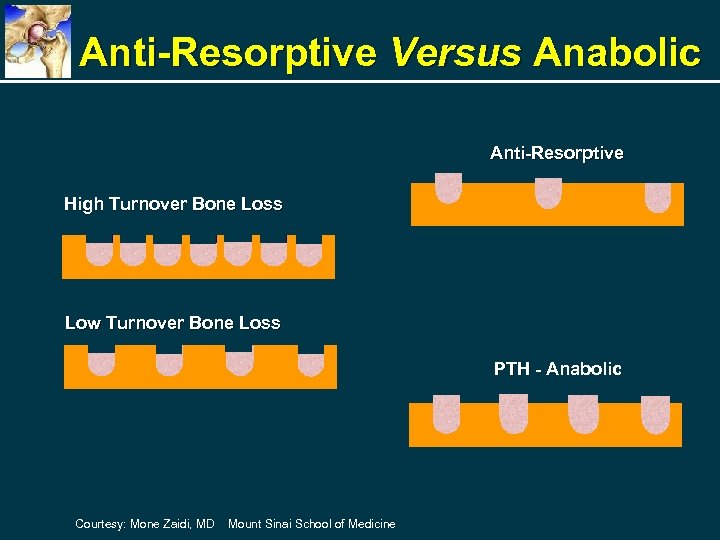 Anti-Resorptive Versus Anabolic Anti-Resorptive High Turnover Bone Loss Low Turnover Bone Loss PTH -
