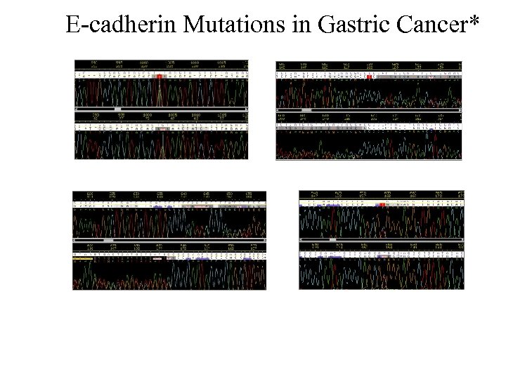 E-cadherin Mutations in Gastric Cancer* Exon 5 splice mutation (IVS 5 +1 G to