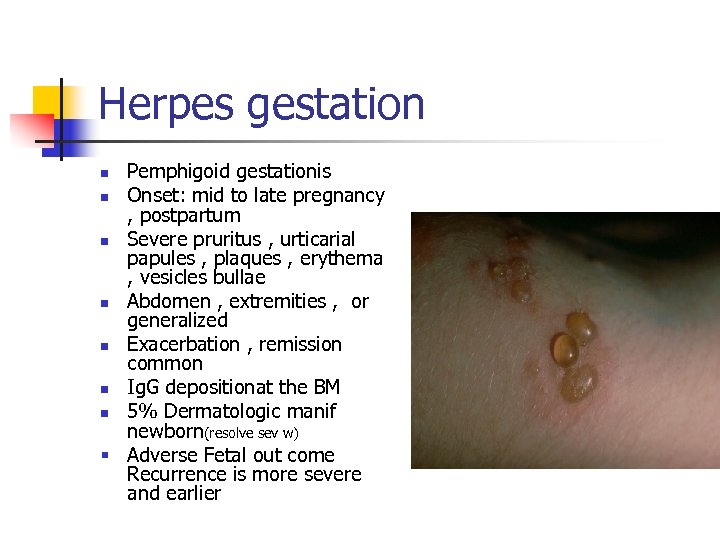 Herpes gestation Pemphigoid gestationis n Onset: mid to late pregnancy , postpartum n Severe