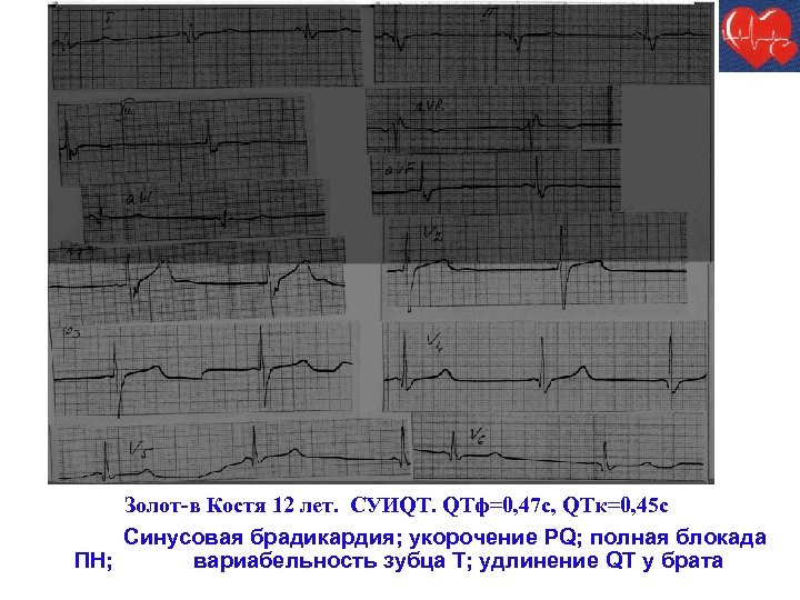 Феномен укороченного pq