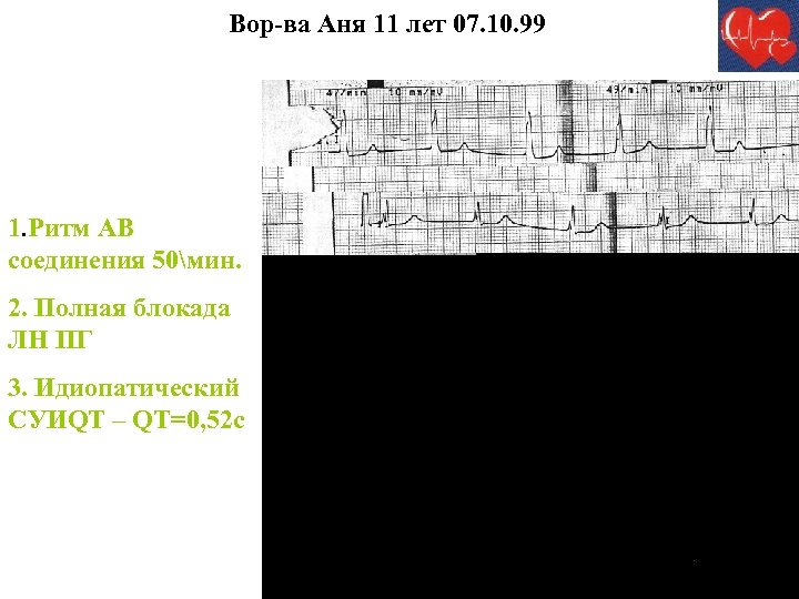 Вор-ва Аня 11 лет 07. 10. 99 1. Ритм АВ соединения 50мин. 2. Полная